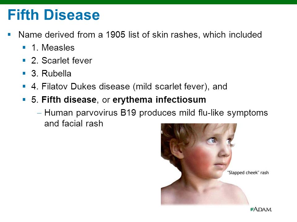 Fifth Disease (Parvovirus, Erythema Infectiosum)